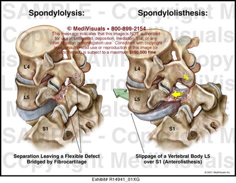 Spondylolysis vs. Spondylolisthesis MediVisuals Medical Illustration