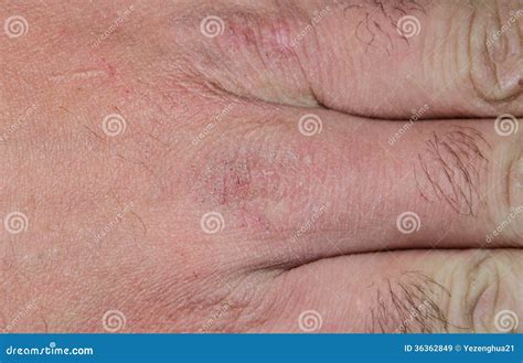 Hand Dry Cracked Skin In The Winter Royalty Free Stock Images - Image ...