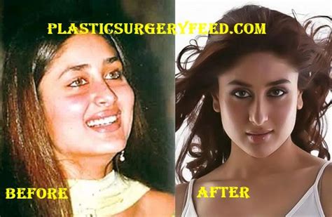 Kareena Kapoor Plastic Surgery - Plastic Surgery Feed