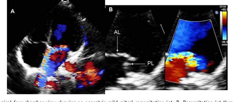 Figure 1 from Isolated cleft of the posterior mitral valve leaflet ...