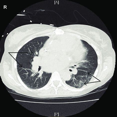 CT scan of the chest showing bilateral lungs ground-glass and... | Download Scientific Diagram