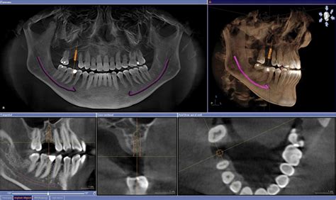 Dental Implant Services - Burkhart Dentistry