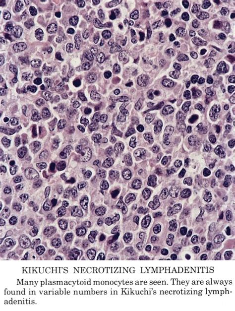 Pathology Outlines - Kikuchi disease