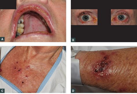 RACGP - Stevens Johnson syndrome due to topical imiquimod