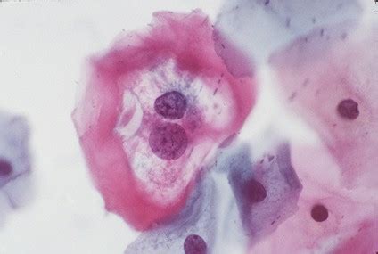 Human Papilloma Virus (HPV)