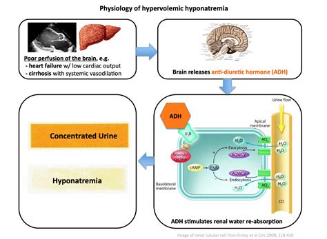 Unconventional therapies for hyponatremia: Thinking outside the ...