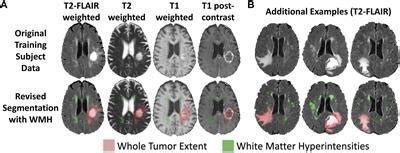 Frontiers | Multi-Disease Segmentation of Gliomas and White Matter Hyperintensities in the BraTS ...