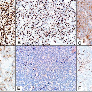 Immunohistochemical profile of Merkel cell carcinoma Merkel cell ...