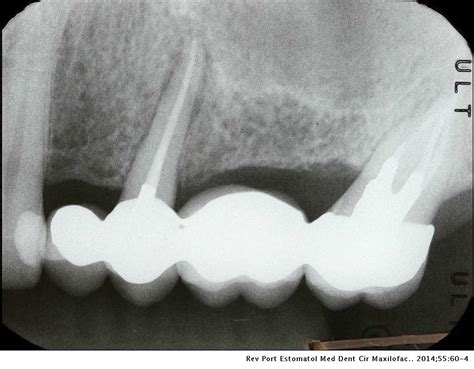 Vertical root fracture diagnosis of crowned premolars with root canal treatment – Two case ...