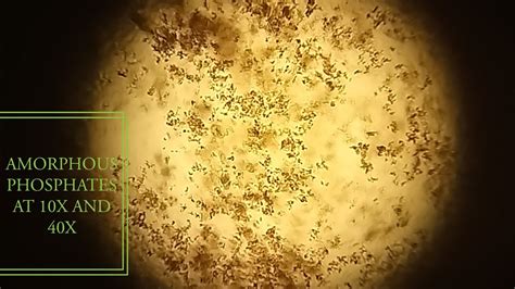 Amorphous phosphates crystals under microscope at 10X and 40X. - YouTube