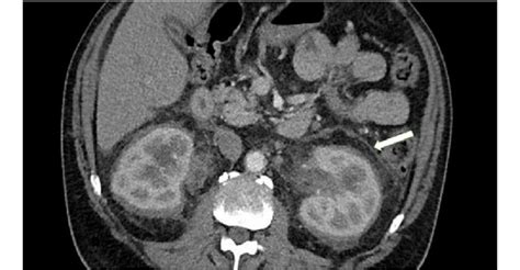 Perinephric soft tissue stranding and encasement on CT abdomen pelvis ...