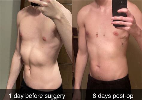 Before and after nuss procedure! AMA : r/PectusExcavatum