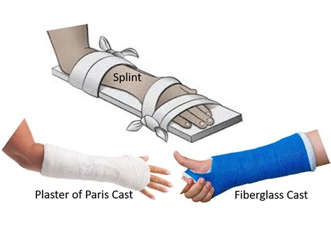 Fracture casts and splint