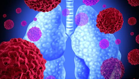 SCLC vs. NSCLC: What's the Difference? | NFCR Lung Cancer