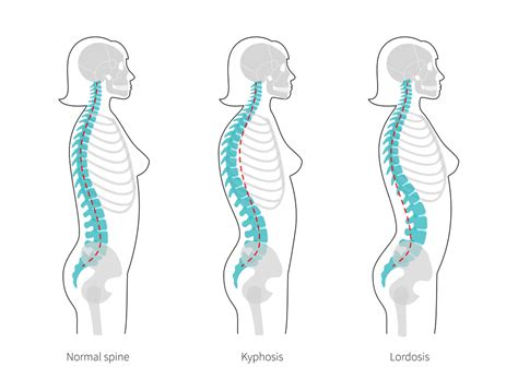 How Can Chiropractic Treat Cervical Lordosis?