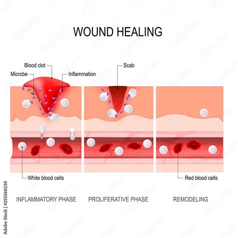 wound healing process. Tissue injury and inflammation. Stock Vector ...