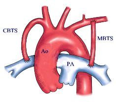 23 B-T Shunt ideas | stenosis, pulmonary, arteries