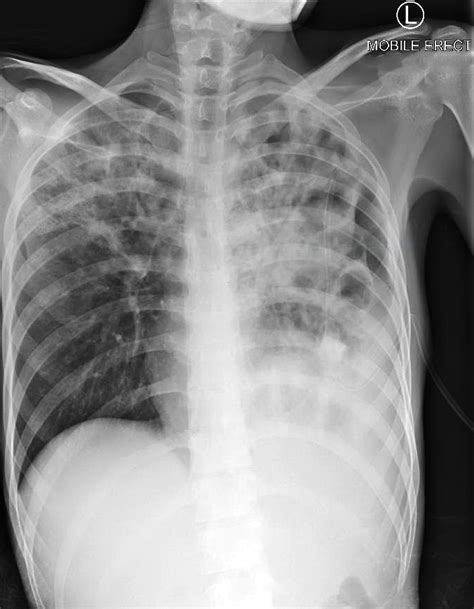 Diffuse Consolidation | Test Findings - MedSchool