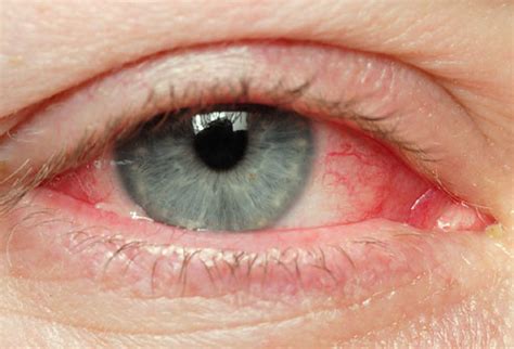 Medical Pictures Info – Eye Disease