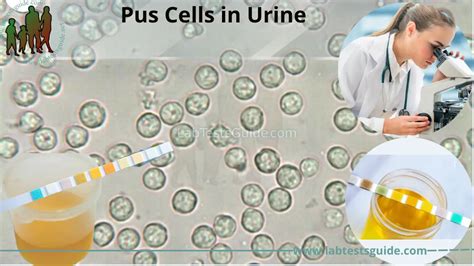 Pus Cells in Urine | Lab Tests Guide