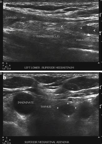 Ultrasonography of the Parathyroid Glands | Radiology Key