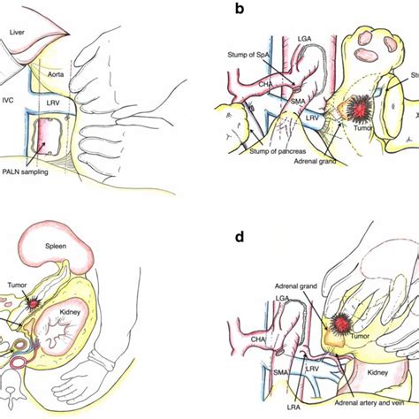 The key steps of modified RAMPS were illustrated. a Kocher’s maneuver... | Download Scientific ...