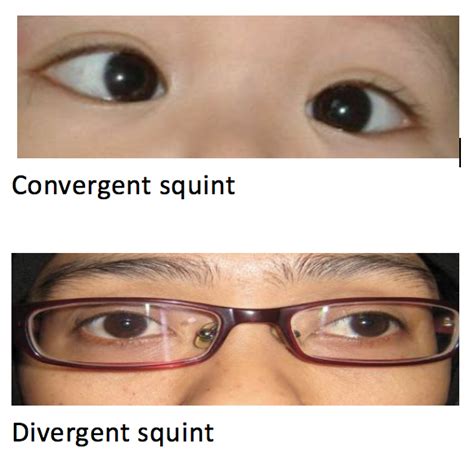 Squints (Strabismus) - OasisEye Specialists