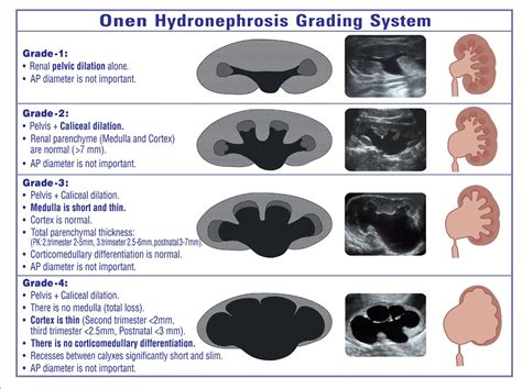 Grading of Hydronephrosis: An Ongoing Challenge | Semantic Scholar