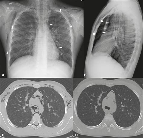 SciELO - Brasil - Hamman's syndrome accompanied by pneumorrhachis Hamman's syndrome accompanied ...