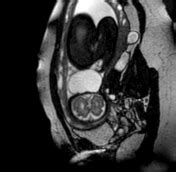 Cystic hygroma vs occipital meningocele | Radiology Reference Article ...