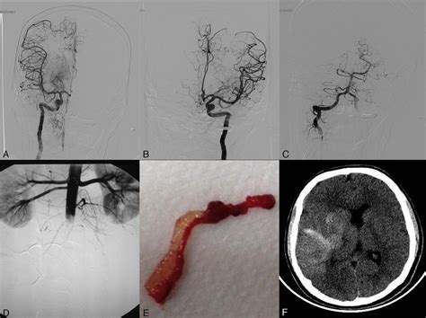 (A) Angiogram of the right internal carotid artery (anteroposterior... | Download Scientific Diagram