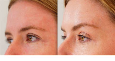 Botox And How To Get A Brow-Lift – Non surgical brow lift