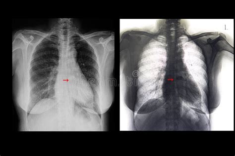 Diagnosis Cardiomegaly Stock Illustrations – 8 Diagnosis Cardiomegaly Stock Illustrations ...