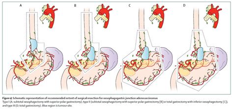 Cancer care for the whole patient gateway, gastric cancer latest treatment