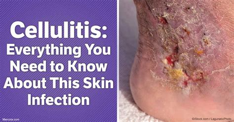 Cellulitis Causes And Symptoms / Cellulitis - Symptoms and causes / The ...