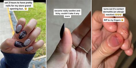 S’pore Woman Has Allergic Reaction To Gel Manicure, Warns Others To Be Careful