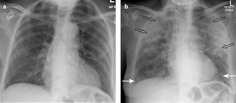 Lung Cancer Vs Pneumonia Xray