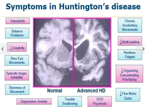 Pin on Information about Huntington's disease