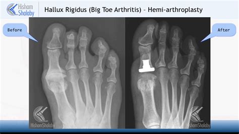 Big Toe Joint Replacement - Orthopaedic Foot & Ankle Surgeon - Edinburgh - Mr. H Shalaby