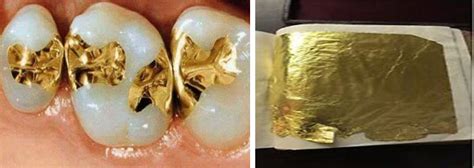 Direct Filling Gold - Focus Dentistry