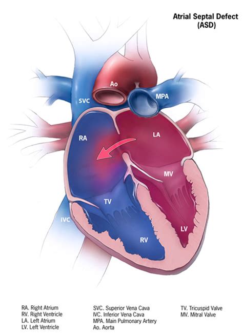 ASD Closure Device | ASD Catheter | ASD Treatment