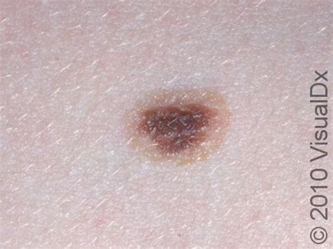 Mole (Nevus) Condition, Treatments and Pictures for Adults - Skinsight