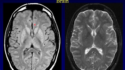 Introduction to Neuroradiology Part 1 - YouTube