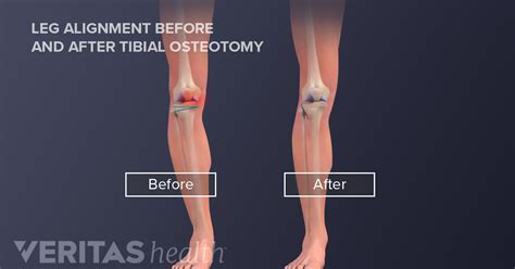 Osteotomy Definition | Defined by Arthritis-Health