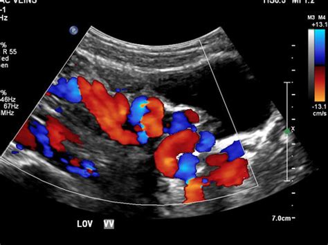 Dedicated to Venous Reflux Testing - Truffles Vein Specialists