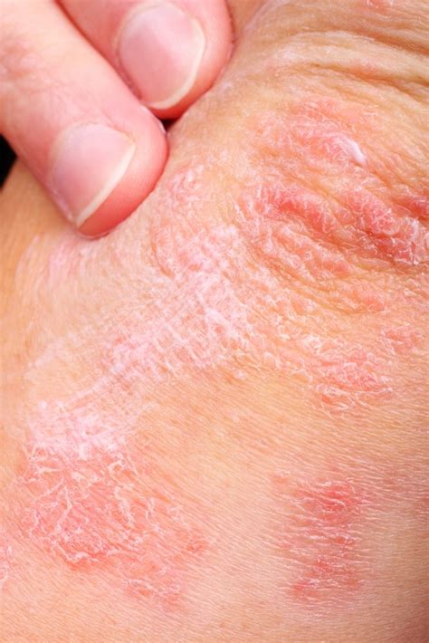 10 Possible Causes For Those Bumps on Your Skin | Home remedies for psoriasis, Psoriasis ...