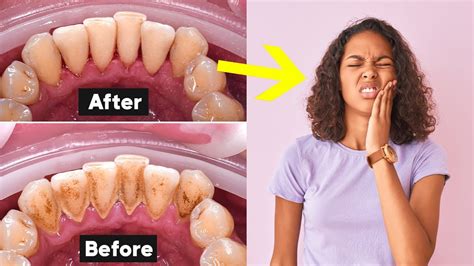 Deep Teeth Cleaning Recovery Tips (How To Heal Fast) - YouTube