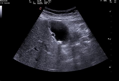 Adenomyomatosis Gallbladder