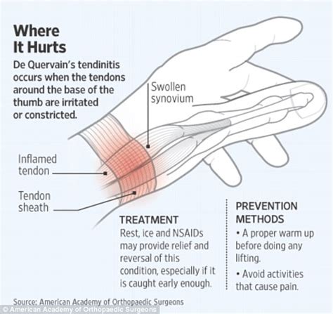 Smartphone thumb is becoming a major problem in the US | Daily Mail Online