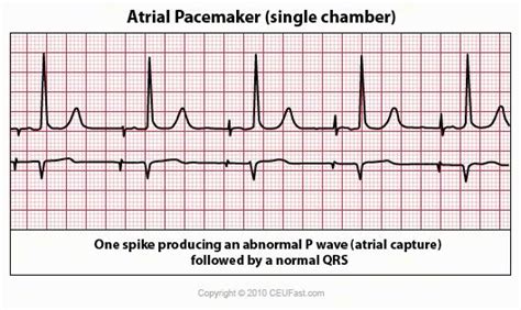 Atrial Pacemaker Rhythm Strip | Nursing | Pinterest | Cardiac anatomy